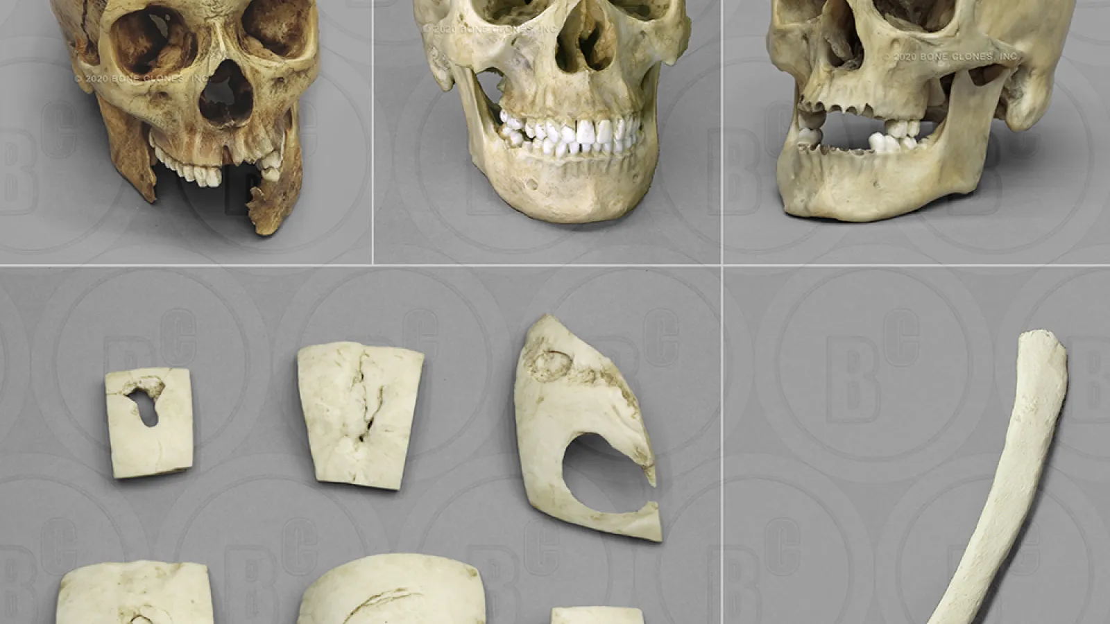 3 skulls and pieces of bones showing traumas
